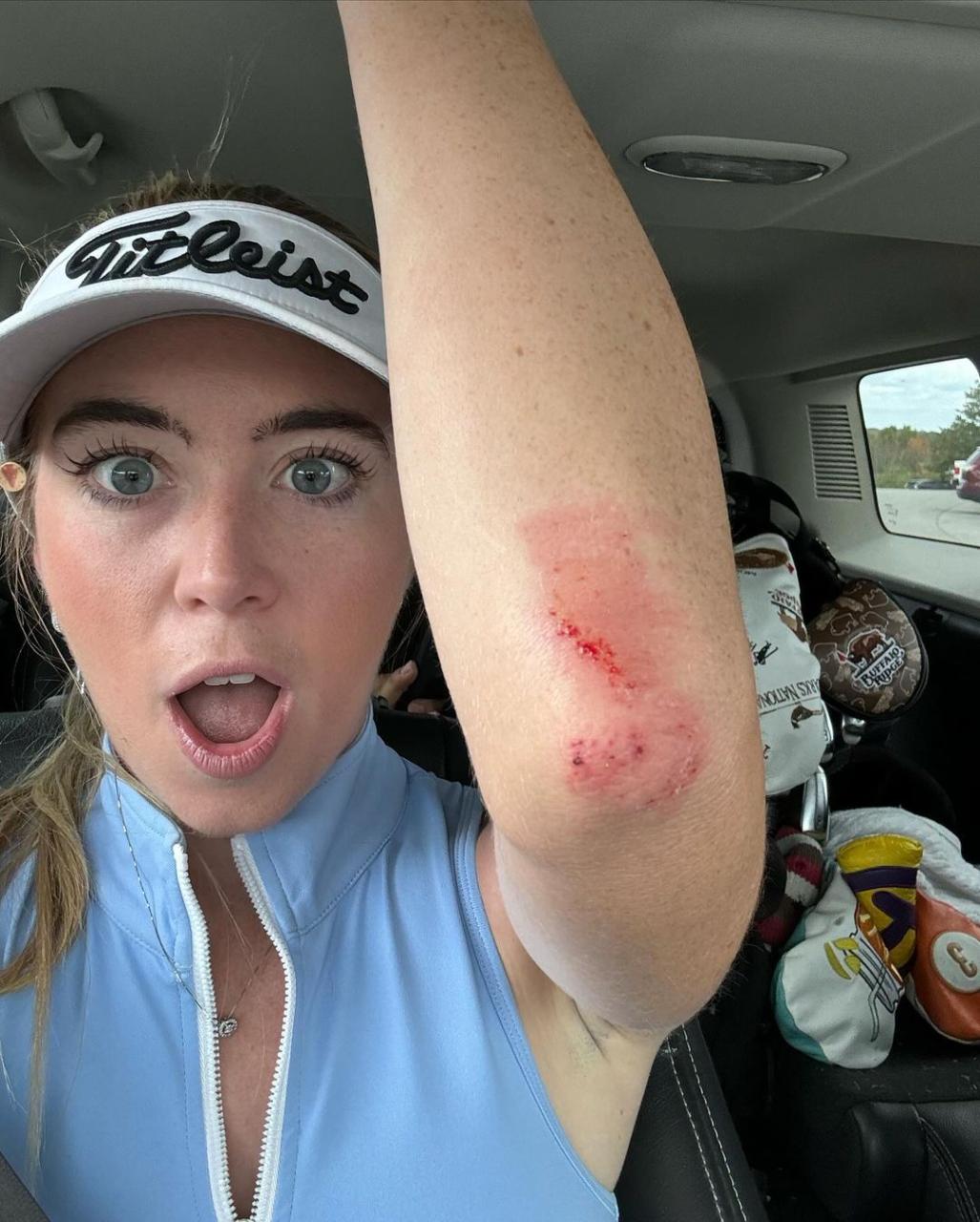 She shared an injury she picked up on the course