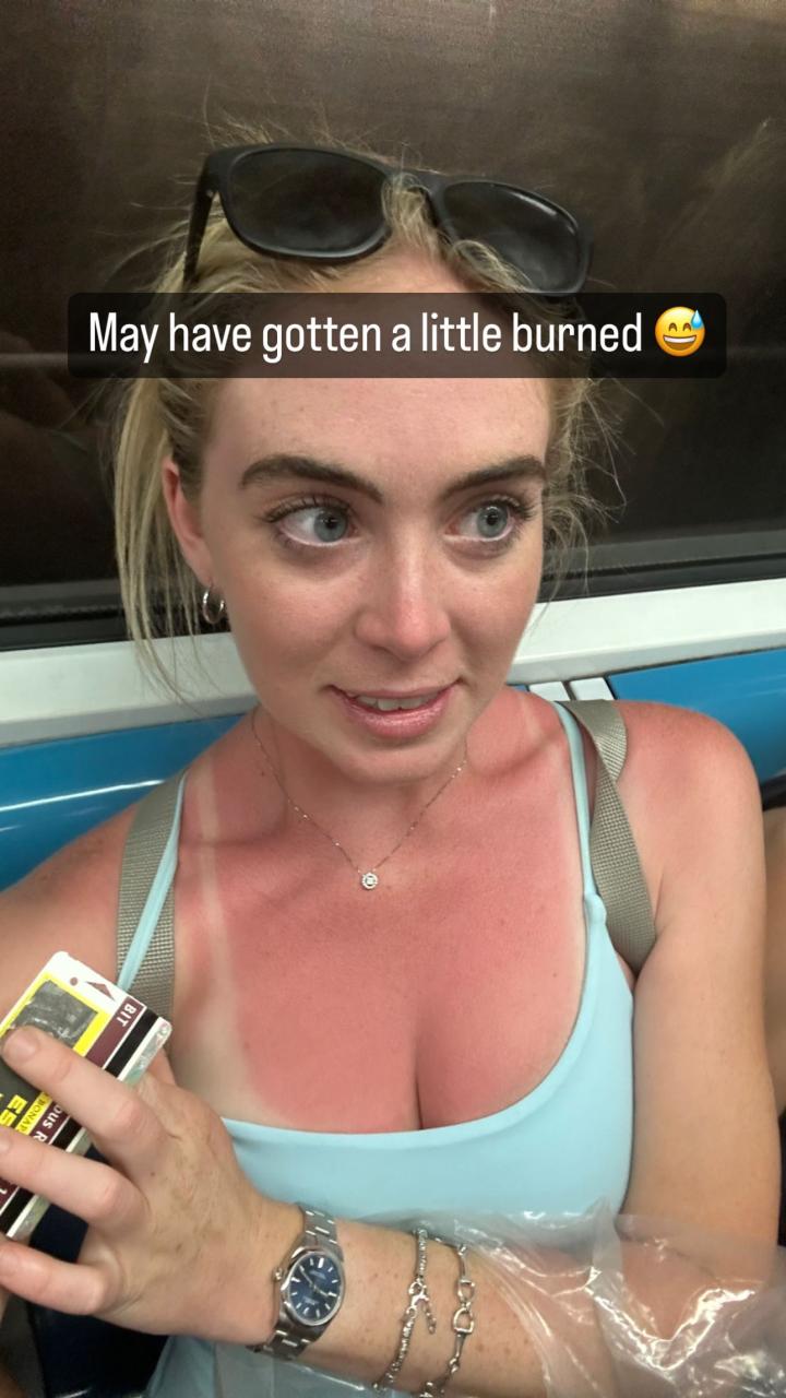 And she was left a little sunburnt during her trip